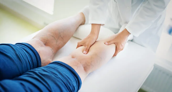 What Complications Can Occur From Removing Spider Veins?