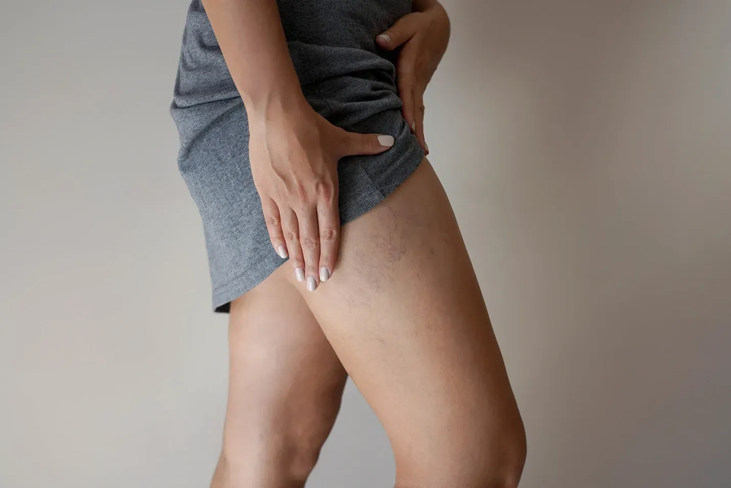 Dermatomyositis Periungual Telangiectasia: A Guide for