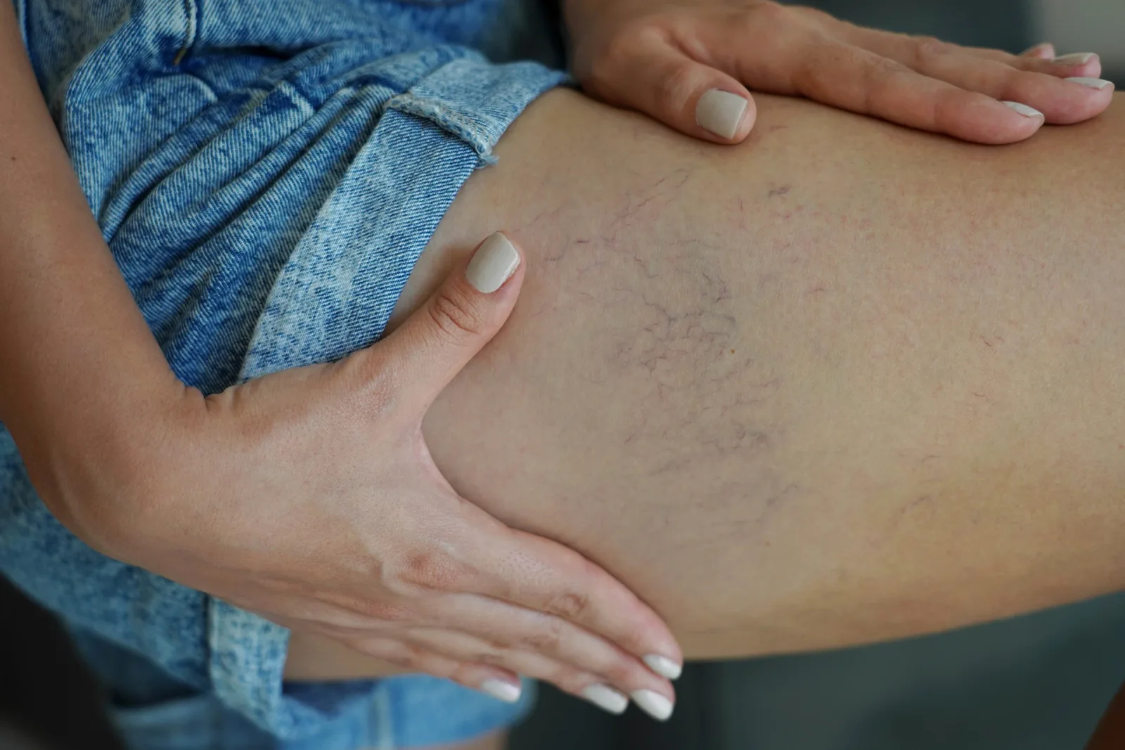 How Do Spider Veins Feel When They Start?