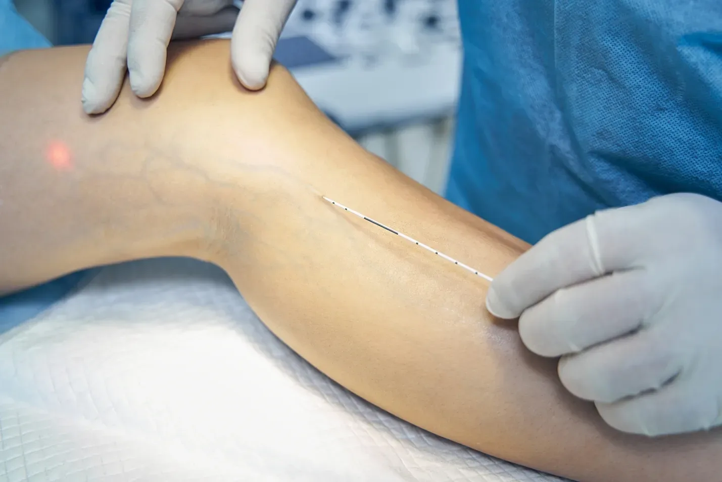 How Long Does Thread Vein Removal Take to Heal?