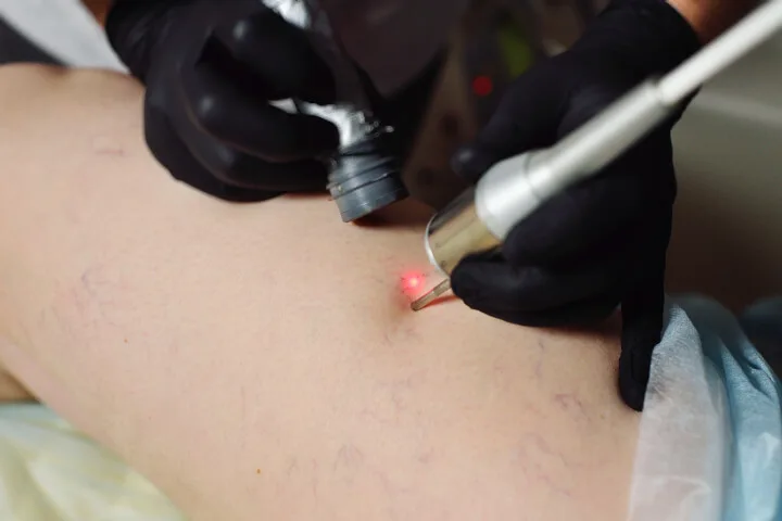 laser spider vein removal therapy