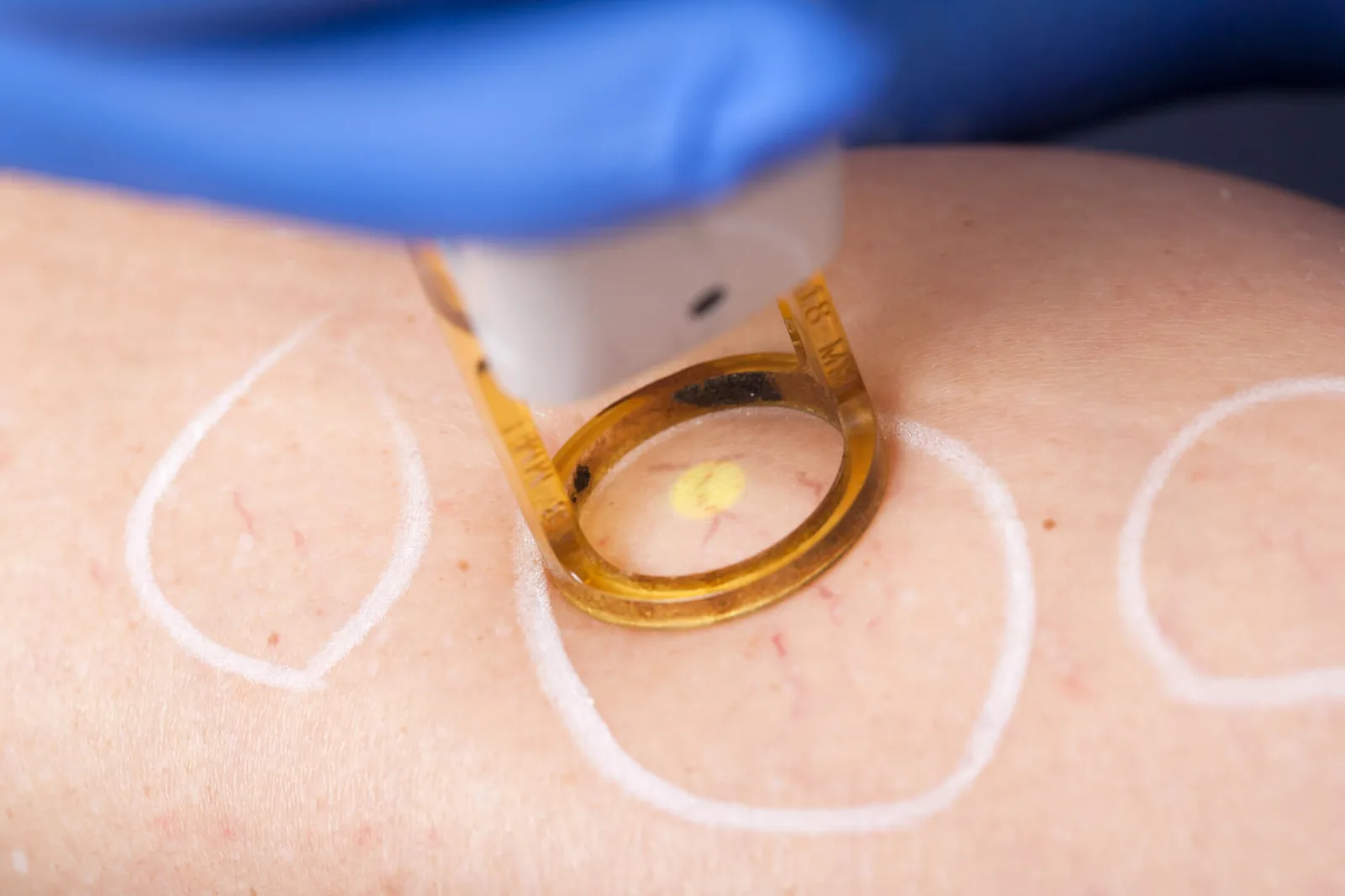 Laser Treatment For Spider Veins