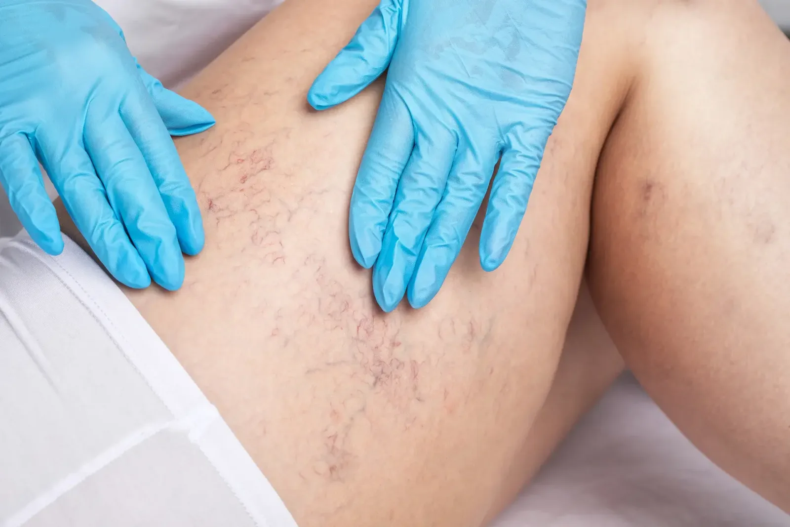 Spider Veins and Petechiae: Understanding the Spots on Your