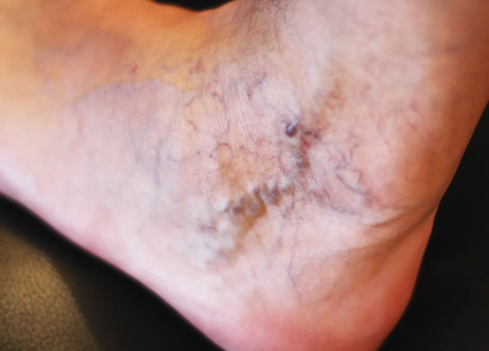 Spider Veins Stages: Understanding Progression, Symptoms,