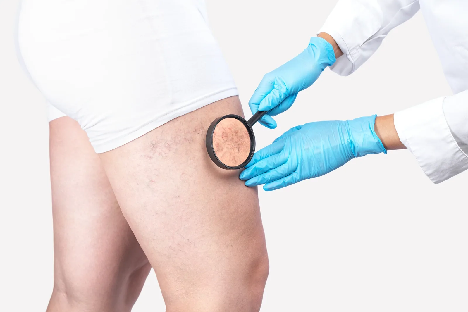 What Are My Different Treatment Options For Chronic Venous